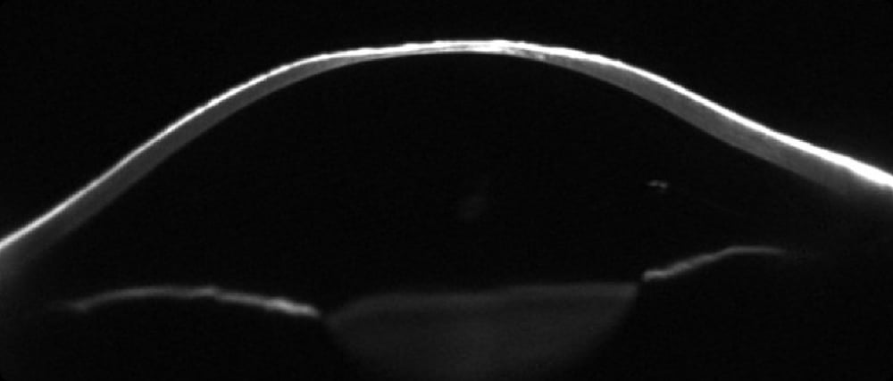 side image of an eye with keratoconous