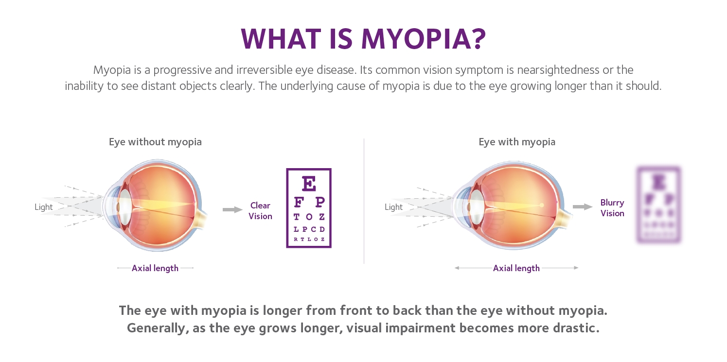 What Is Myopia graphic