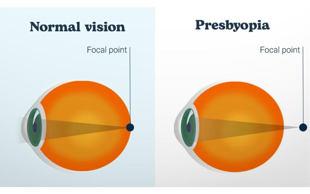 Presbyopia and Treatment Options: Progressive Addition Lenses or Multifocal Contact Lenses