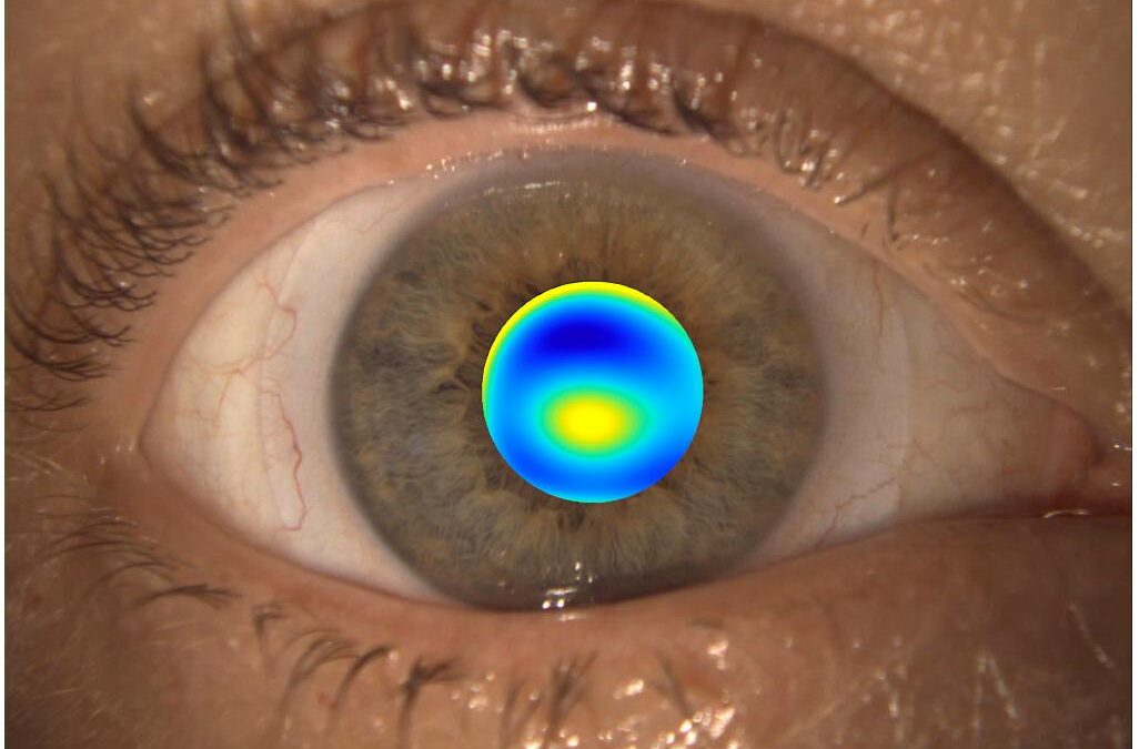 Wavefront Guided Scleral Contact Lenses: The Future of Precision Vision Correction