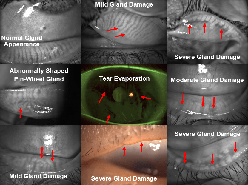 Envision By Inmode Advanced Dry Eye And MGD Treatments Envision By Inmode Advanced Dry Eye And MGD Treatments