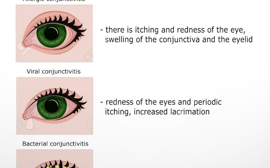 Conjunctivitis – Viral Infections and How to Minimize Risks of Infection