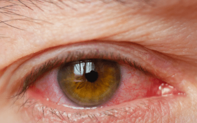 Allergy Season in Katy: How to Protect Your Eyes Naturally