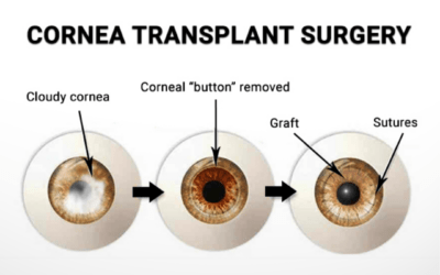 Corneal Transplants – Types of Transplants and What You Should Know