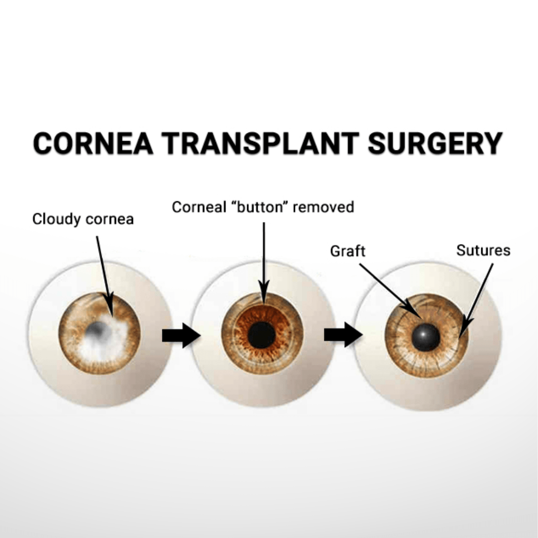 Corneal Transplant Types PK DMEK DALK Explained Contemporary Eye corneal-transplant-types-pk-dmek-dalk-explained-contemporary-eye