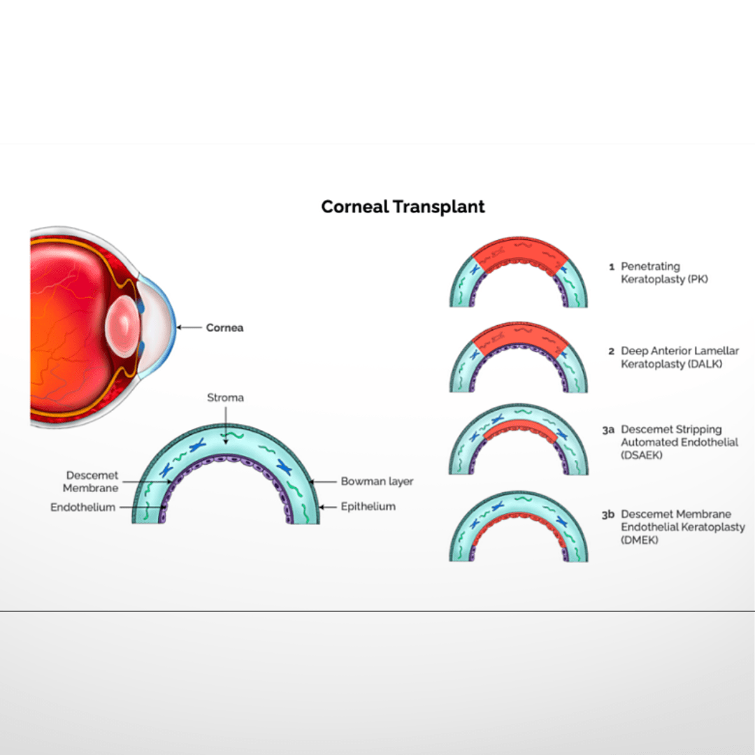 Medical diagram comparing corneal transplant types including PK, DALK, DSAEK, and DMEK layers