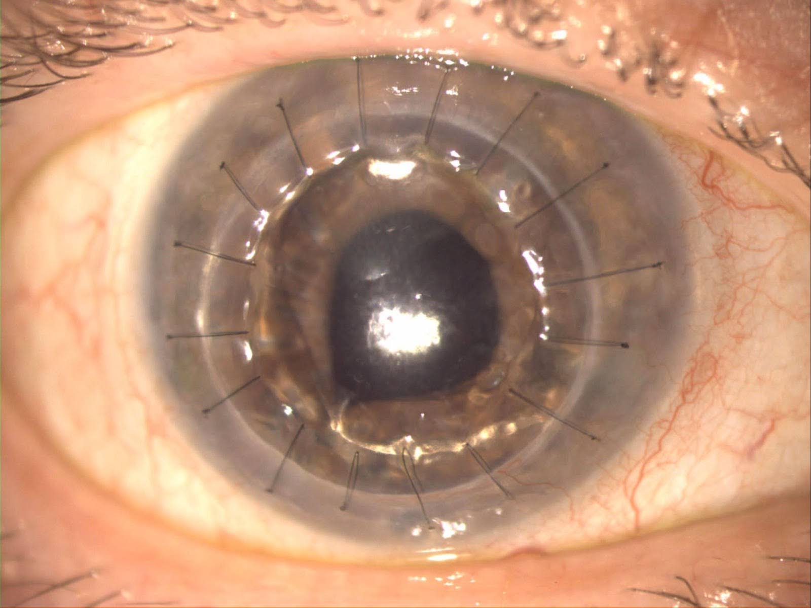 Close-up of eye following corneal transplant surgery with sutures visible in Katy TX patient