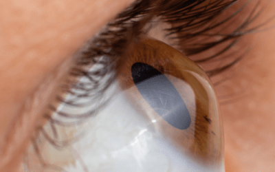 Living with Keratoconus: A Guide to Regaining Clear, Comfortable Vision